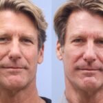 Facial Rejuvenation