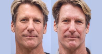 Facial Rejuvenation