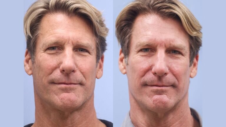Understanding Facial Rejuvenation: Techniques and Trends