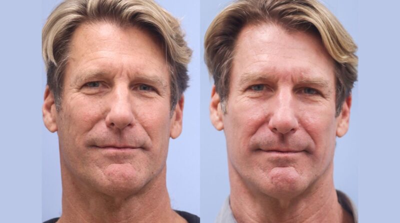 Facial Rejuvenation